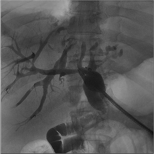 Fluoroscopic image from ERCP—a representative image from the patient’s ERC. This demonstrates biliary ductal dilation but no signs of obstructing stones or stricture. Additionally, this image illustrates the cystic cavity does not communicate with the biliary system.
