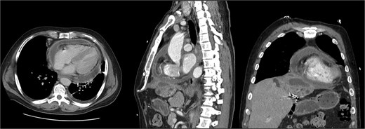 Second readmission imaging—CT of the chest in the axial, sagittal, and coronal views. These demonstrate that the abscess has eroded through the diaphragm and now abuts the pericardium. Additionally, it shows a worsening of the pericardial effusion, concerning for abscess communication.