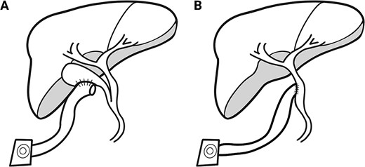 PEBD diagram. (A) A diagram representing the typical post-surgical anatomy for PEBD. This includes isolating a small bowel conduit and anastomosing this to the gallbladder. The other end is brought out through the skin to form an ostomy that will drain bile and stones. This is commonly done in children with chronic biliary stasis. (B) A diagram of the anatomy encountered in this case. The anatomy is similar, except the gallbladder is surgically absent, and the conduit is anastomosed directly to the biliary tree.