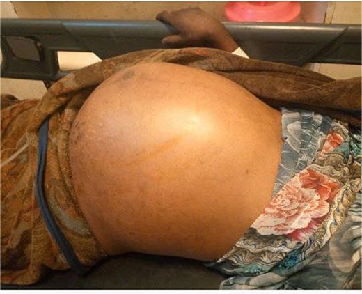 Photograph showing a grossly distended abdomen postpartum in the patient.