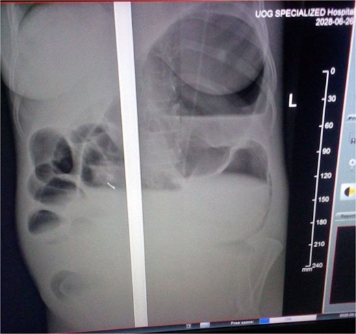 Abdominal X-ray showing the dilated colon and multiple air-fluid levels.