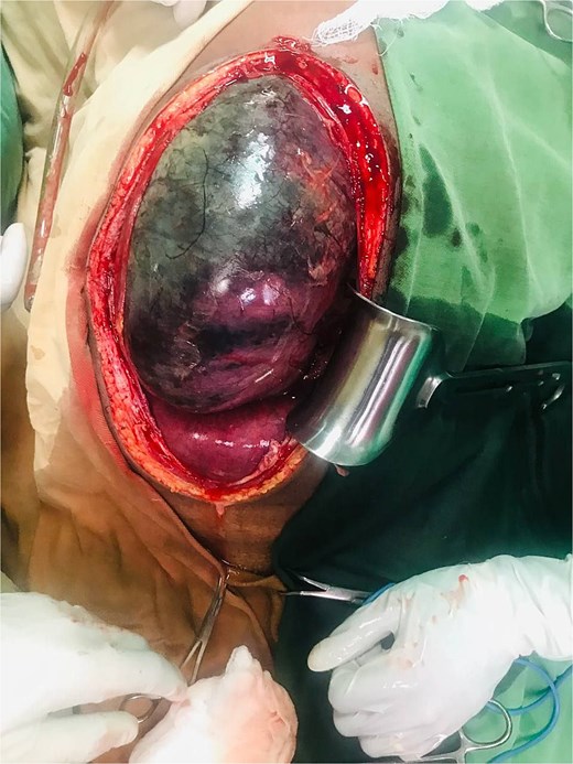 Dilated, gangrenous cecum twisted with descending colon and distal ileum.