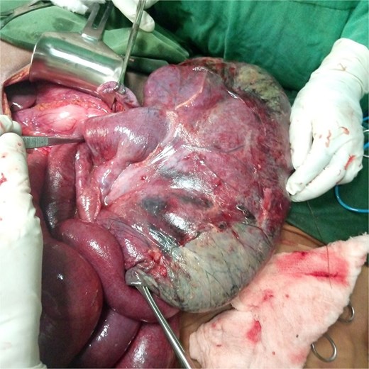 Picture showing an elongated appearance of the stomach.