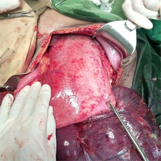 Picture of cecum following detorsion.