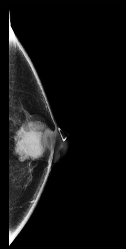 Diagnostic mammogram of left breast showing heterogenous retroareolar mass – first view.