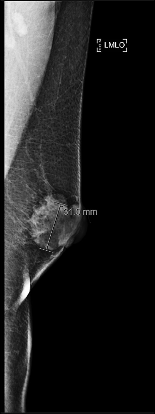 Diagnostic mammogram of left breast showing heterogenous retroareolar mass – second view.