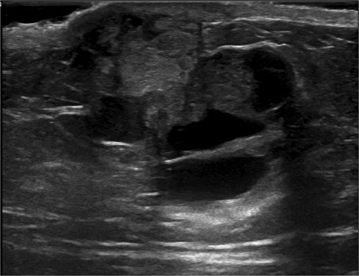 Ultrasound of retroareolar area of palpable concern – first view.