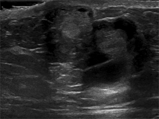 Ultrasound of retroareolar area of palpable concern – second view.