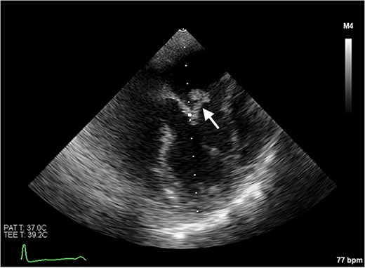 Transoesophageal echocardiogram showing the pedunculated mass on the anterior mitral valve leaflet.