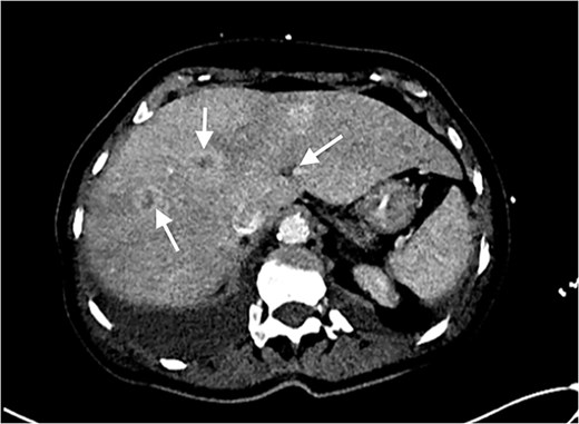 Axial CT image of the liver, showing multiple lesions, initially thought to be septic emboli.