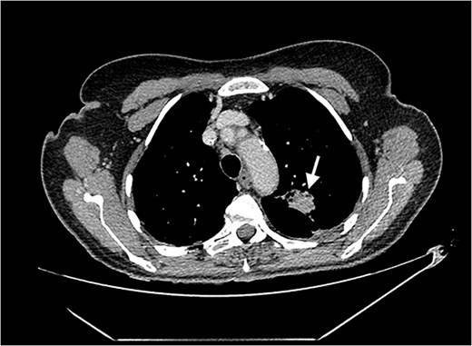 Axial CT image of the lungs, showing a cavitating mass in the posterior aspect of the left upper lobe, suggestive of an abscess secondary to infective endocarditis.