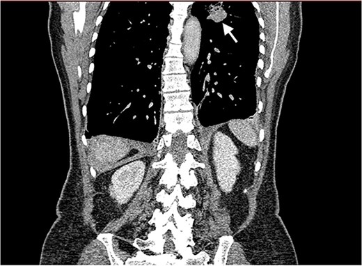 Coronal CT image of the lungs showing the cavitating mass suspected to be an abscess.