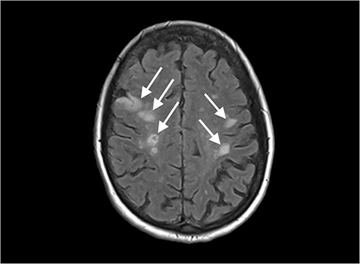 Diffusion-weighted magnetic resonance imaging image of the brain, showing multiple lesions.