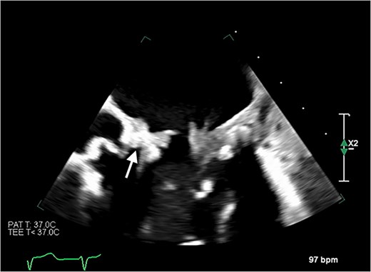 Transoesophageal echocardiogram showing thromboses on the bioprosthetic mitral valve leaflets, as well as in the left atrium and the inferior vena cava. Thrombus is also visible on the non-coronary cusp of the aortic valve.
