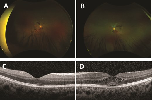 Ultra-widefield red–green retinal image of the right eye (A) and left eye (B), with scattered retinal haemorrhages extending from the optic nerve head. Optical coherence tomography of the macula of the right eye (C) and left eye (D). Right eye (C) shows a normal macula. Left eye (D) shows retinal thickening with intraretinal cystic areas and a foveal pigmented epithelial detachment.