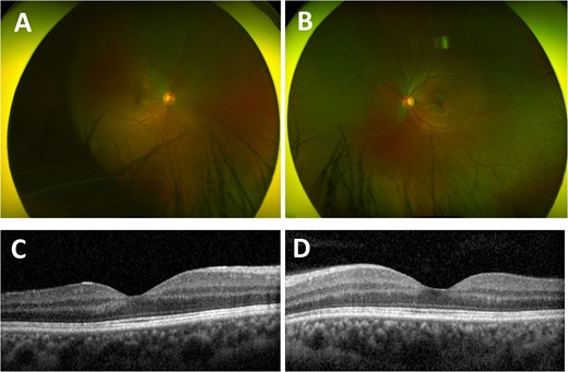 Ultra-widefield red–green retinal image of the right eye (A) and left eye (B) 2 months after completion of induction therapy, with resolved haemorrhagic retinopathy. Optical coherence tomography of the macula of the right eye (C) and left eye (D) 2 months after completion of induction therapy, both showing normal maculae.