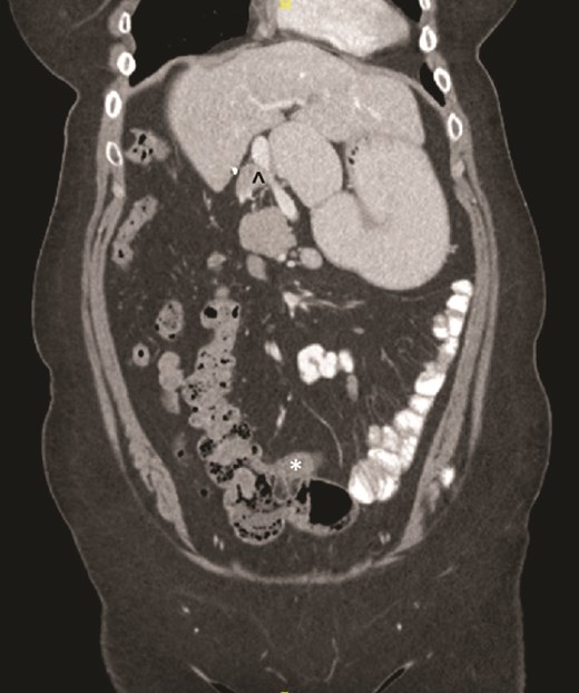Terminal ileum (*) seen entering cecum with completely right-sided colon and left-sided small bowel visible. PDPV also seen (^) causing partial duodenal obstruction.