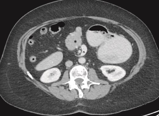 Partial agenesis of the dorsal pancreas (*). Superior mesenteric vein (^) seen to the left of the superior mesenteric artery.