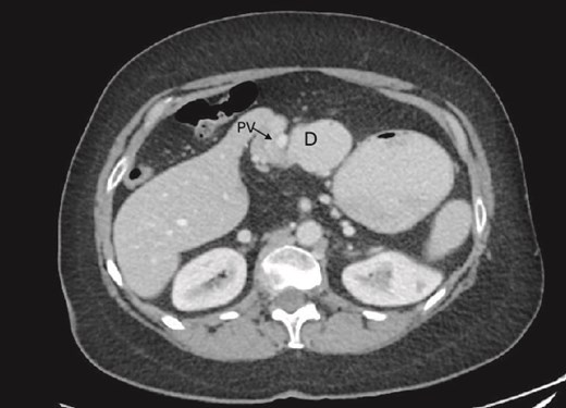 Preduodenal PV seen crossing the duodenum (D) causing partial obstruction.