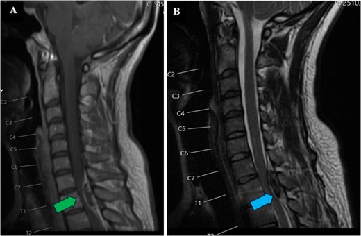 Preoperative MRI of the cervical spine. T1 (A) and T2 (B) sagittal views. Lesion is hyperintense (green arrow) on T1-weighted image and hypointense to isointense (blue arrow) on T2-weighted image at C7-T2 level.