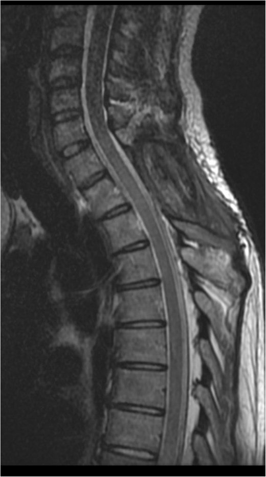 Eight months postoperative T2-weighted sagittal views MRI of the cervical spine.