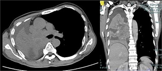 CT scan thorax with contrast showed enhancing solid mass measuring ±9.6 × 9.5 × 14.5 cm in the centre of the right lung extending to the entire right lung, middle, and subcarinal mediastinum mass.