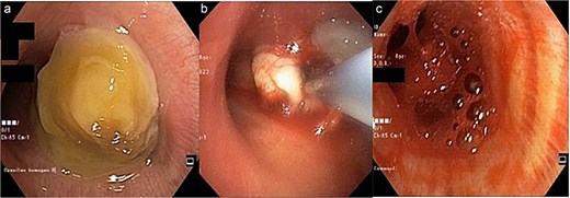 (a) Mass at the proximal of the right main bronchus, left main bronchus was still patent; (b) a cryobiopsy was performed on an intraluminal mass in the right main bronchus; (c) bleeding 5 minutes after the cryobiopsy was done which extended to the left main bronchus so it covered both main bronchus.