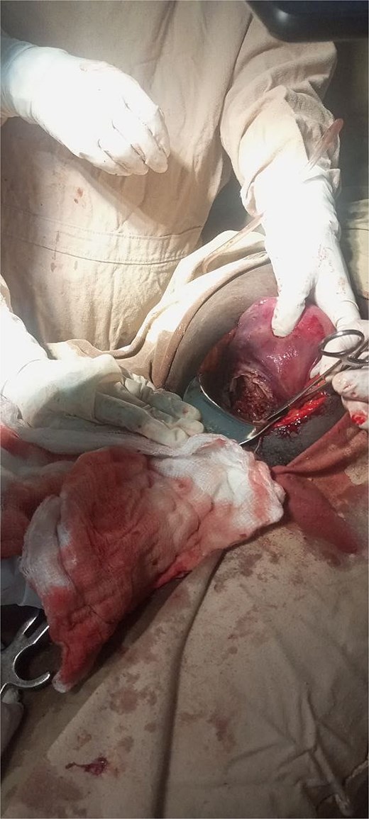 Intraoperative image taken showing complete transverse rupture over the lower uterine segment with necrotic edge.