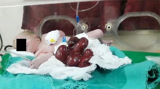 Evisceration of the stomach and small bowel.