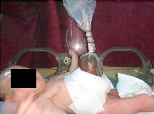 The gastroschisis contents were covered with a sterile sac.