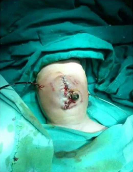 A careful and staged reduction of the herniated bowel was successfully conducted.