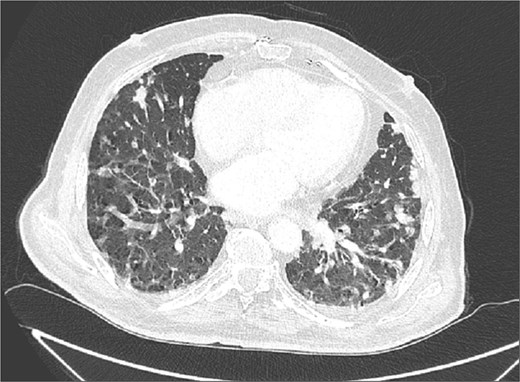 Chest CT revealed multiple pulmonary nodules.