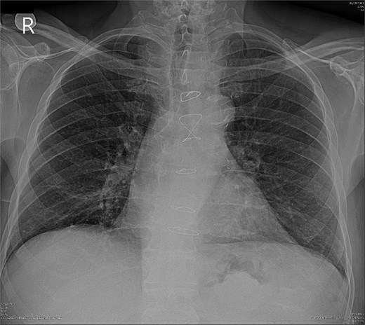 Preoperative chest X-ray.
