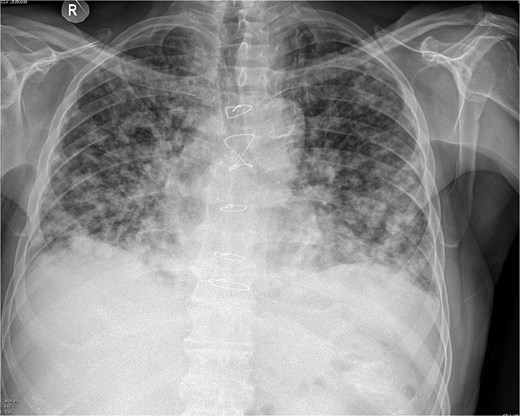 Chest X-ray eight months after TURP.