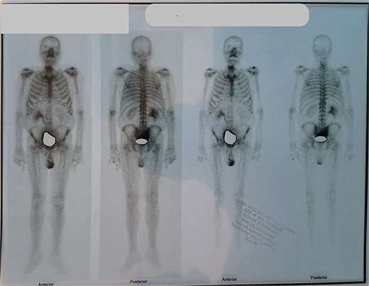 Bone scan was negative for metastatic lesions in bones.
