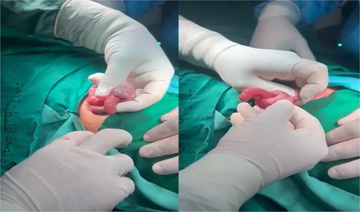 Ileocecal intussusception with the inflamed appendix invaginated inside the intussusception.