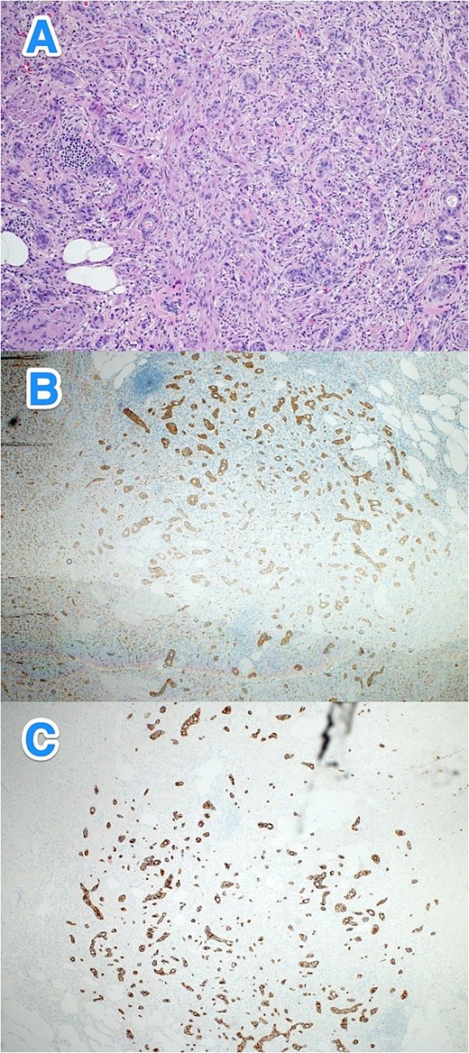 Light microscopy photographs of the appendix show (A) a well-differentiated grade 1 neuroendocrine tumor invading through the muscularis propria into the subserosa, located in the distal half of the appendix. The tumor cells are diffusely positive for (B) synaptophysin and (C) panCK. The Ki-67 labeling index is < 1% (hematoxylin and eosin stain; 2×).