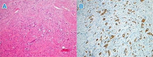 Light microscopy photographs of the appendix show (A) a well-differentiated grade 1 neuroendocrine tumor invading from the submucosa into the muscularis propria, located in the distal half of the appendix (tip). The tumor cells are diffusely positive for (B) synaptophysin (hematoxylin and eosin stain; 2×).