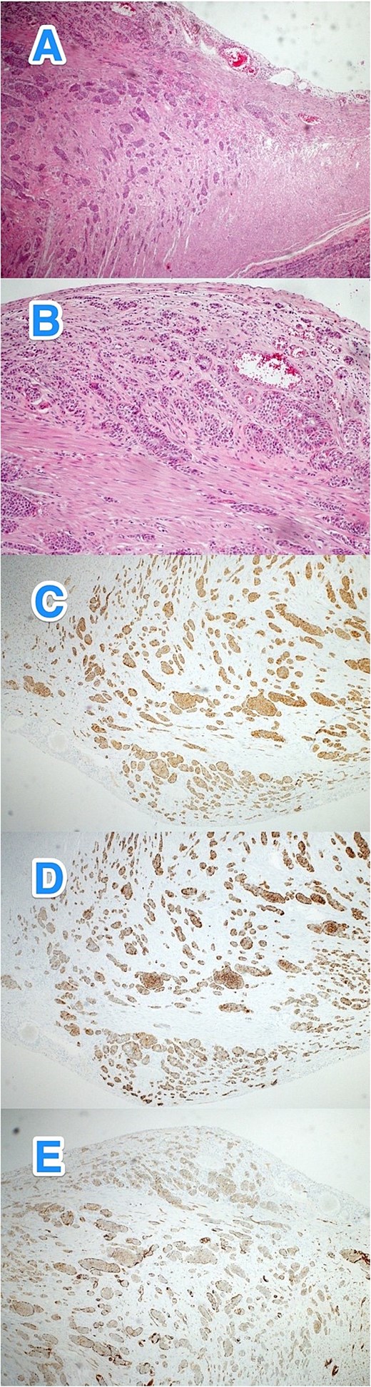 Light microscopy photographs of the appendix show (A, B) a well-differentiated grade 1 neuroendocrine tumor invading from the muscularis propria into the subserosa, located in the distal half of the appendix (tip). The tumor cells are positive for (C) synaptophysin but negative for (D) chromogranin A and (E) CD56. The Ki-67 labeling index is less than 3% (hematoxylin and eosin stain; 2×).
