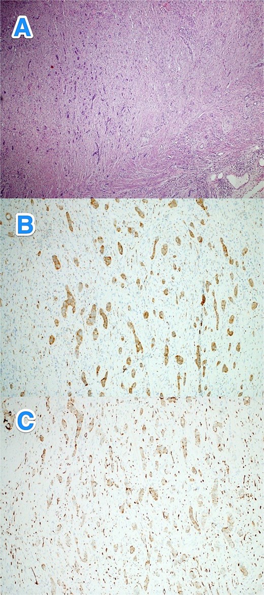 Light microscopy photographs of the appendix show (A) a well-differentiated grade 1 neuroendocrine tumor invading from the muscularis propria into the mesoappendiceal fat, located in the distal half of the appendix. The tumor cells are positive for (B) synaptophysin and (C) CD56 (hematoxylin and eosin stain; 2×).