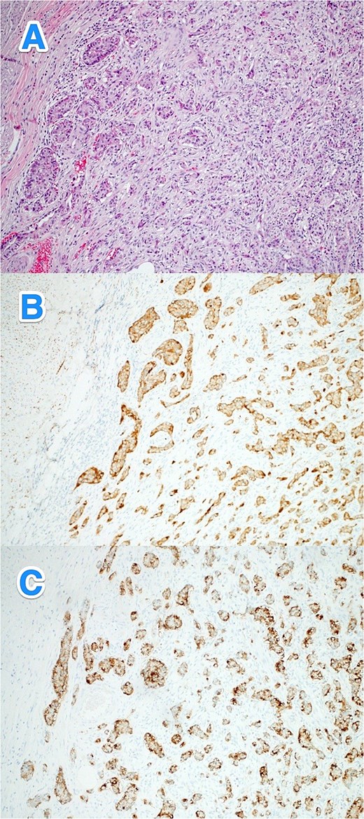 Light microscopy photographs of the appendix show (A) a well-differentiated grade 1 neuroendocrine tumor invading from the submucosa into the muscularis propria, located in the distal half of the appendix. The tumor cells are strongly positive for (B) synaptophysin and (C) chromogranin. The Ki-67 labeling index is less than 2% (hematoxylin and eosin stain; 2×).