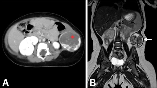 Imaging of the abdominal wall mass. (A) Axial post-contrast CT image in the venous phase demonstrates peripheral centripetal enhancement of the lesion (asterisk). (B) Coronal T2-weighted MRI reveals the anatomical relationships of the mass (arrow).