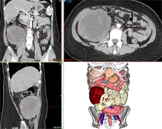 Contrast-enhanced CT showing the retroperitoneal mass, and Mimics23 3D model (tumor: red; ileum; vasculature; 3-Matic®15).