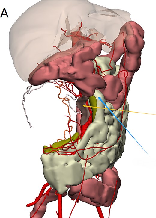 Mimics23 3D model (3-Matic®15 simulation of surgical margins). Blue arrow: ileocecal region; yellow arrow: appendix.