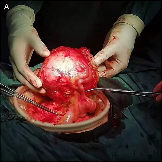 Histopathological analysis shows spindle cell tumor, combined with immunohistochemical results, conforms to high-grade sarcoma, considering extra bone osteosarcoma.