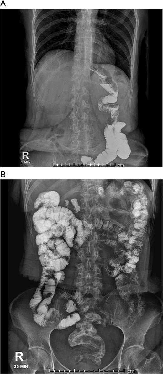 A: Bowel transit time, the complete alimentary limb and the jejunojejunal anastomosis are seen. B: Bowel transit time, in 30 minutes, it reaches the colon and anus.