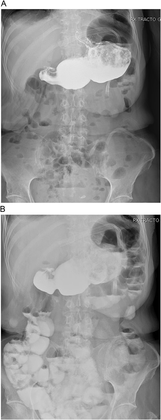 A: Bowel transit time, the whole stomach is seen connected. B: Bowel transit time, the whole stomach is seen along with the bowel.