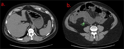 (a) Axial noncontrast CT of the abdomen demonstrating a nondescript, fluid-filled stomach. (b) Axial noncontrast CT reveals dilated loops of small bowel with classic “bowel within bowel” appearance of the small intestine, labeled with an arrow. This was thought to be the lead point for the suspected SBO.
