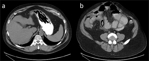(a) Axial CT of the abdomen with oral contrast shows filling defects with stacked, linear objects in the stomach, consistent with possible foreign body ingestion. (b) Axial CT with oral contrast shows dilated loops of small bowel, with a triangular intraluminal filling defect. The previously noted “bowel-within-bowel” appearance is no longer seen. Possible foreign body defect that measured ~3.5 cm in length.