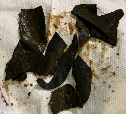 Post endoscopy specimen photo showing over ten pieces of removed shoe insole from the patient’s stomach.